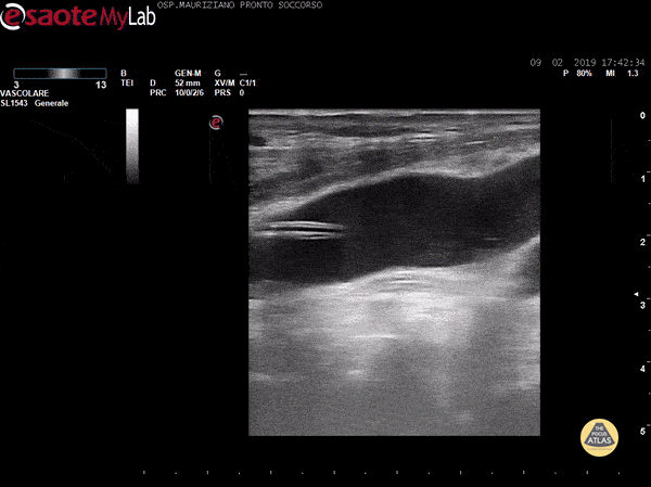 Vascular - CVC kinking in IJV