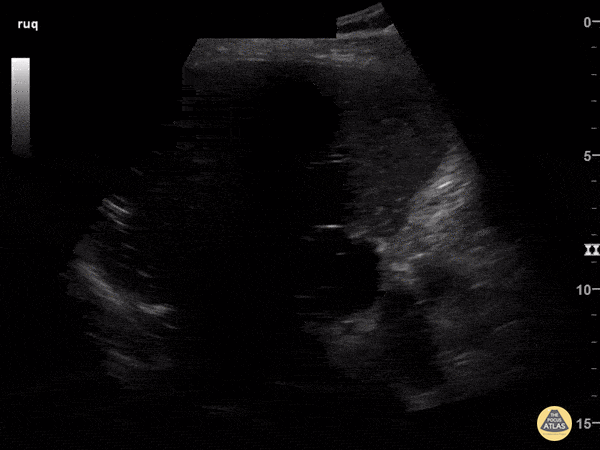 Biliary - Pneumobilia