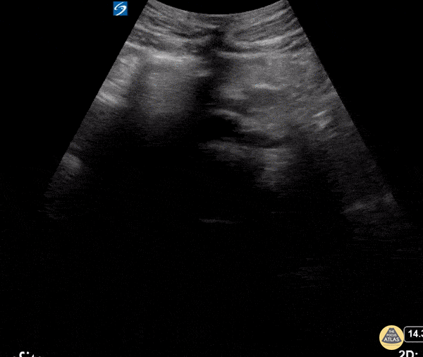 Renal/GU - Horseshoe Kidney