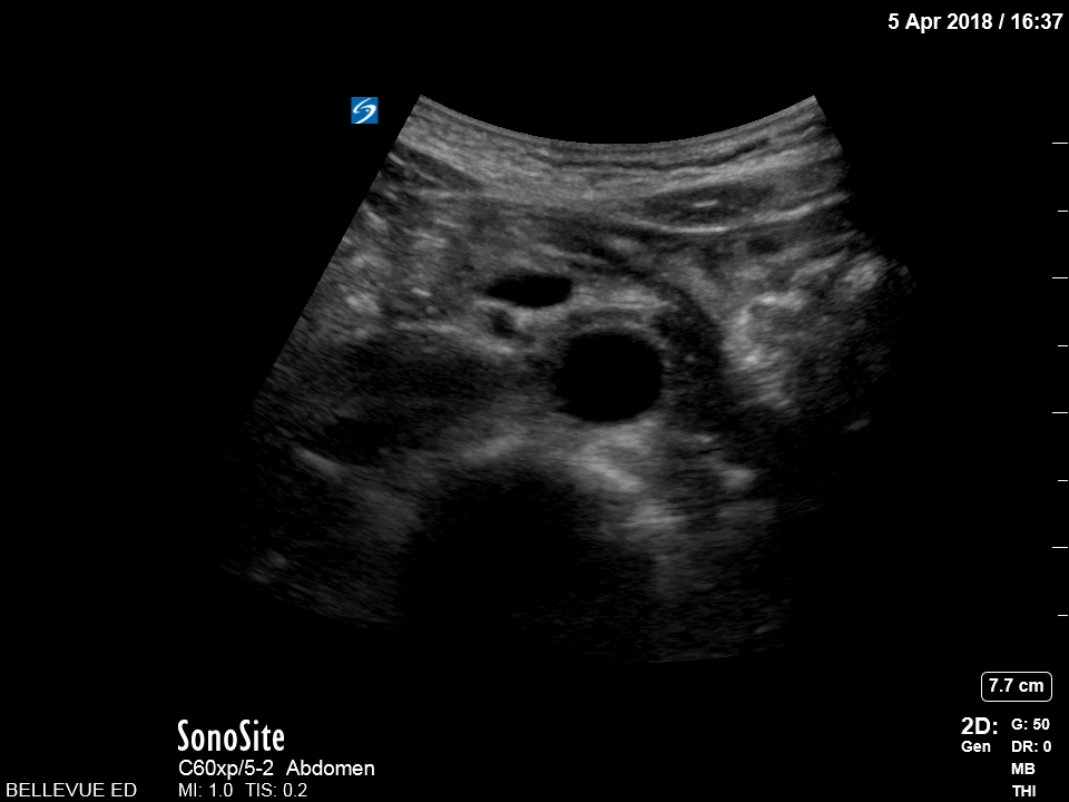 Aorta - Distal Aorta - Colorized