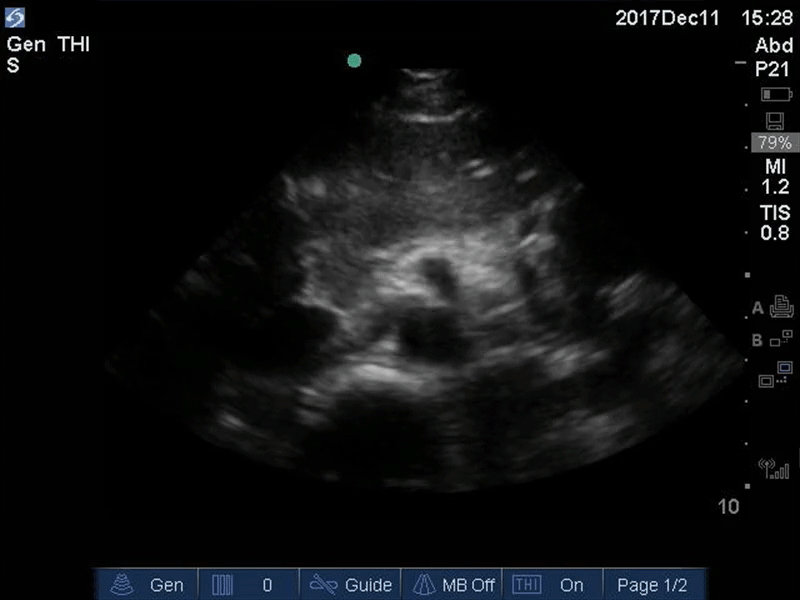 Aorta - Seagull Sign - Colorized