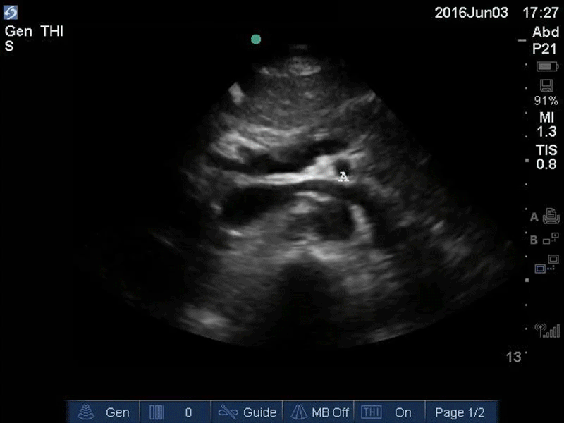 Aorta - Upper Aorta - Colorized - The POCUS Atlas