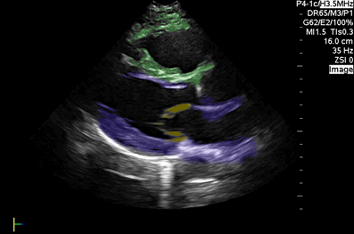 Colorized Atlas - Parasternal Long Axis - Colorized - Simple