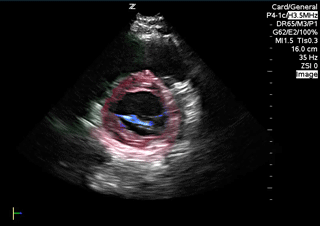 Colorized Atlas - Parasternal Short Axis - Colorized