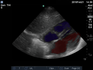 Colorized Atlas - Subxiphoid - Colorized 1