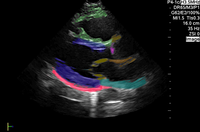 Colorized Atlas - Parasternal Long Axis - Colorized - Complex