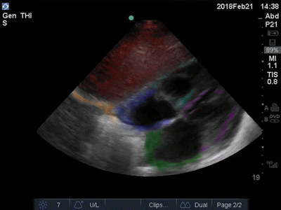 Colorized Atlas - Subxiphoid - Colorized 2