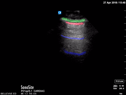 Pulmonary - Lung Sliding - Colorized