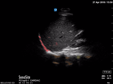 Pulmonary - Pleural Space - Colorized