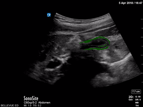 Biliary - Contracted Gallbladder - Colorized