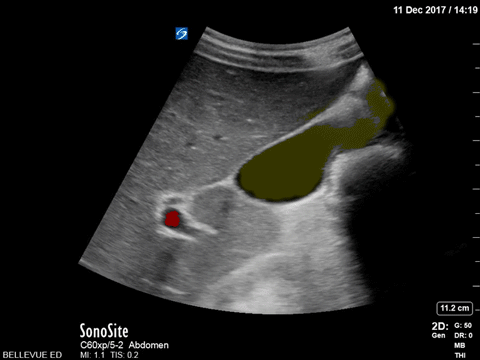 Biliary - Normal Gallbladder - Colorized