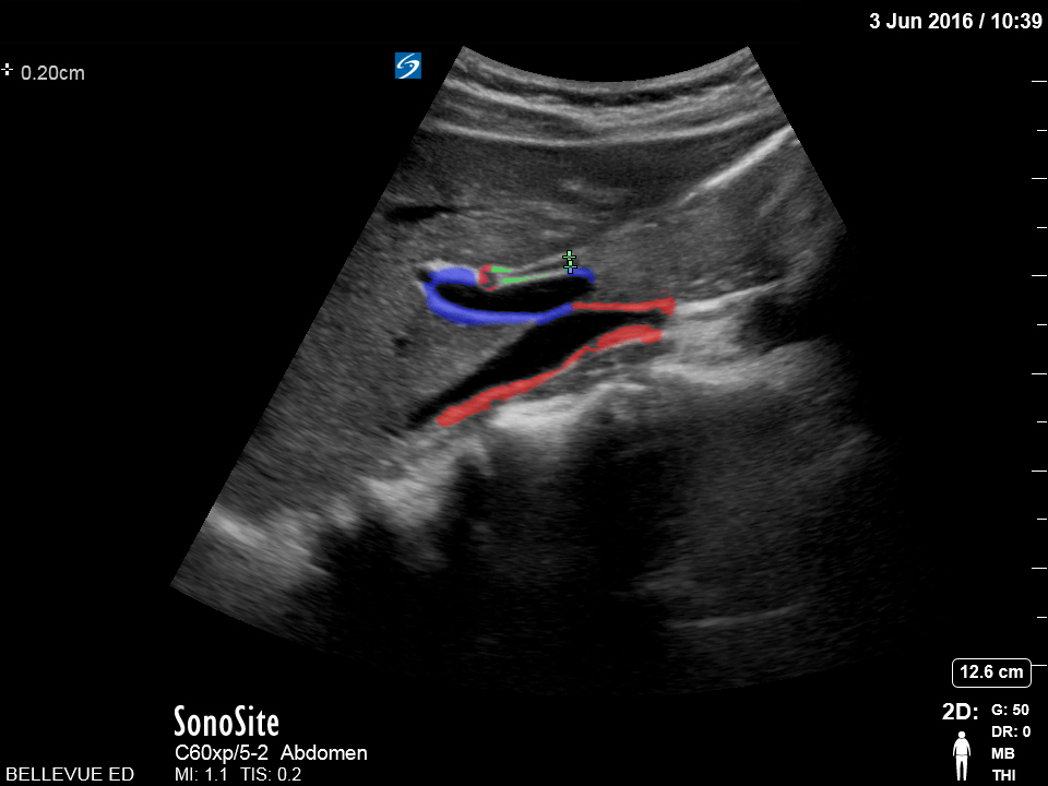 Biliary - Olive Sandwich Sign - Colorized