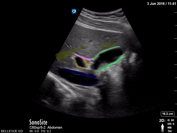 Biliary - Gallbladder and Commmon Bile Duct - Colorized