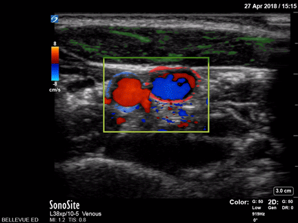 Vascular - Carotid and Internal Jugular Doppler - Colorized
