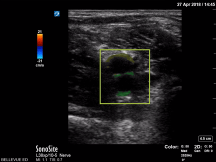 Vascular - Popliteal Vasculature - Colorized