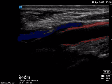 Vascular - Carotid Bulb Long Axis - Colorized