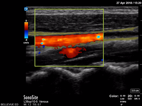 Vascular - Internal Jugular and Common Carotid Doppler (long axis) - Colorized