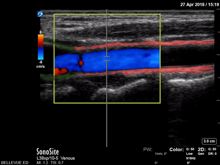 Vascular - Common Carotid Long Axis - Colorized