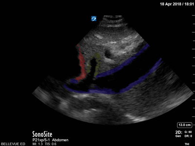 Colorized Atlas - Inferior Vena Cava and Hepatic Vein - Colorized
