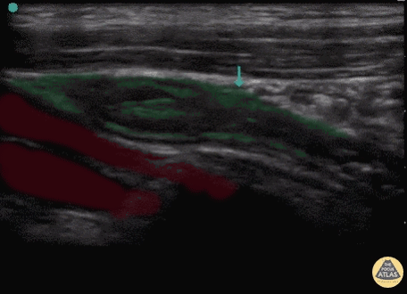 Bowel-GI - Appendix - Colorized