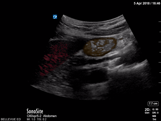 Bowel-GI - Duodenum - Colorized