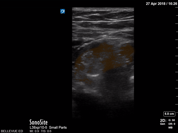 Bowel-GI - Large Bowel - Colorized