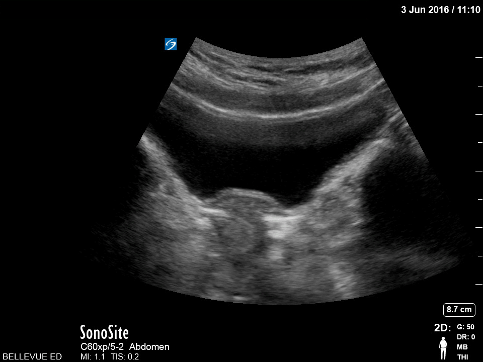 OB/Gyn - Transabdominal Uterus Transverse View - Colorized