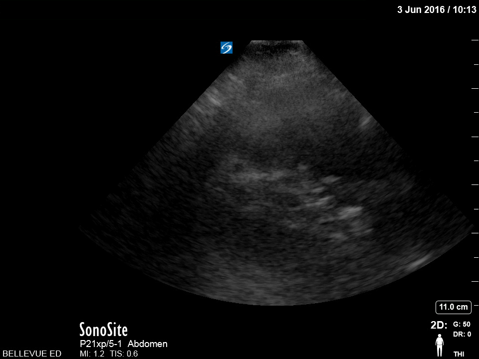 Renal/GU - LUQ Kidney - Colorized
