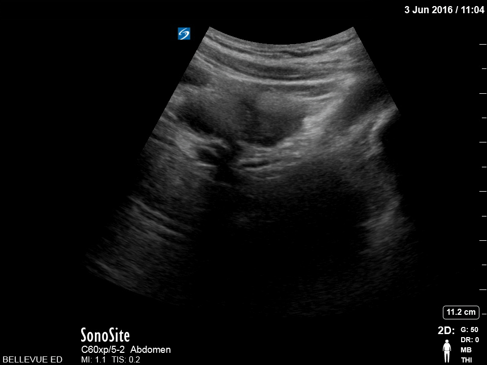 OB/Gyn - Transabdominal Uterus Sagittal View - Colorized