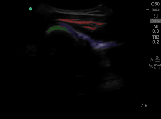 Musculoskeletal - Shoulder - Colorized