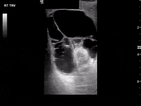 Renal/GU - Epididymitis with Complex Hydrocele