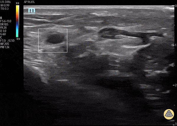 Vascular - Post Arterial Catheterization Complication
