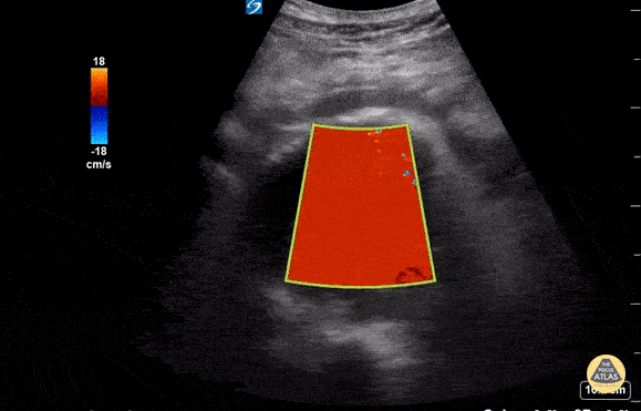 Aorta - POCUS Utility in Suspected AAA Rupture