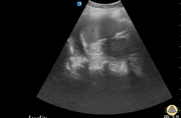 Pulmonary - Pleural Effusion After Blunt Trauma