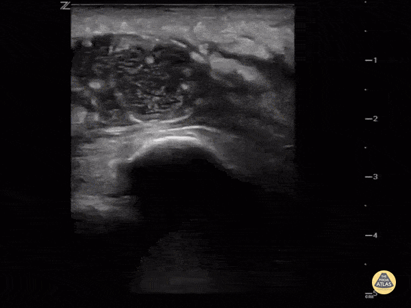 Soft Tissue - Intra-articular or extra-articular?