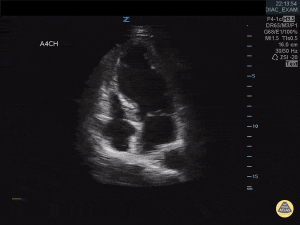 Left Ventricular Dysfunction - Takotsubo Cardiomyopathy in a Patient with Chest Pain