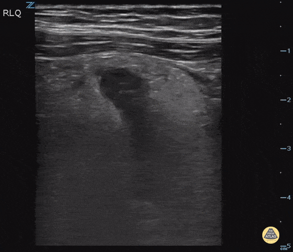 Bowel-GI - Acute Appendicitis with Appendicolith