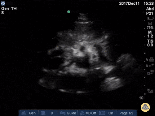 Aorta - Seagull Sign