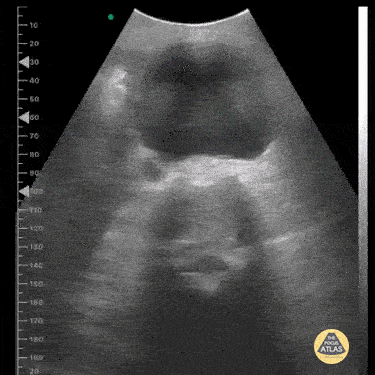 Aorta - Abdominal Aortic Aneurysm