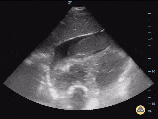 Pericardial Disease - Pericardial Effusion with Hematoma