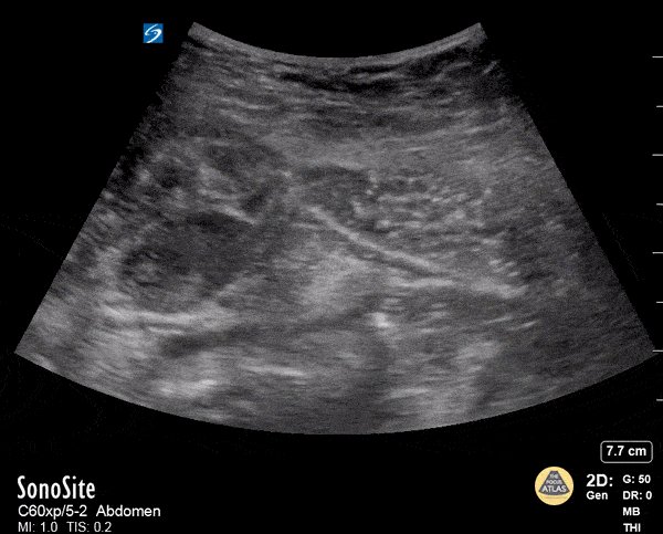 Musculoskeletal - Rectus Abdominis Hematoma