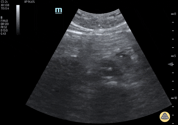 Aorta - Extensive Type B Aortic Dissection