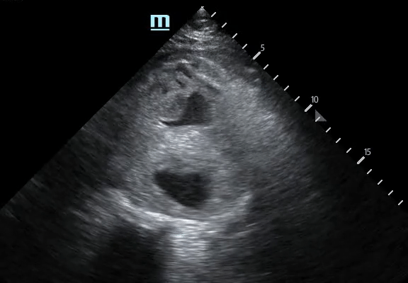 Aorta - AAA Rupture: Not Your Typical Flank Pain