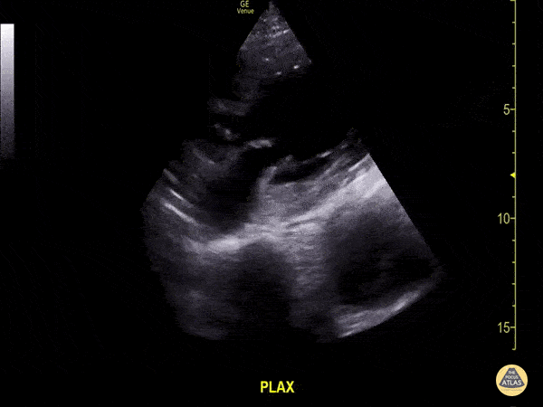 Aorta - Thoracic Aorta Aneurysm with Intramural Thrombus