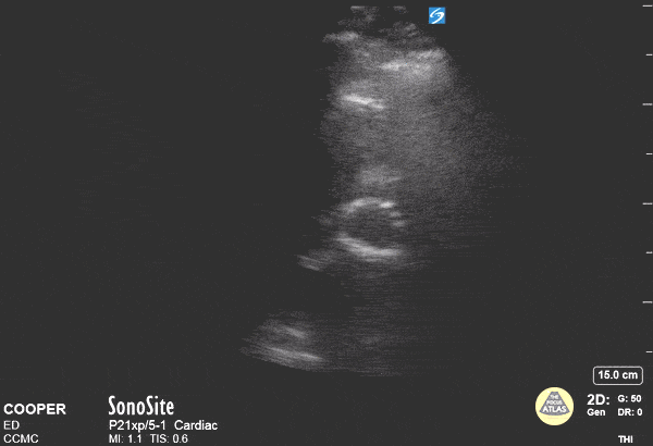 Valvulopathy - TAVR in Short Axis