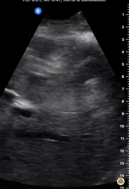 Biliary - Gallstone Stuck in GB Neck with Shadowing