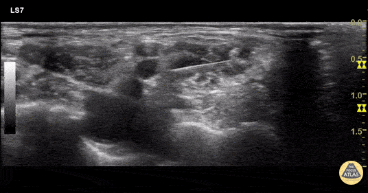 Nerve Block Gallery - Interscalene Block