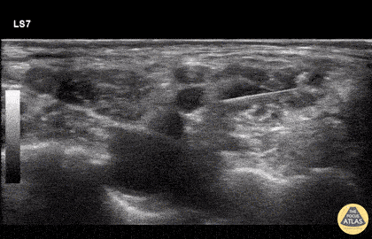 Nerve Block Gallery - Interscalene Block - High Speed