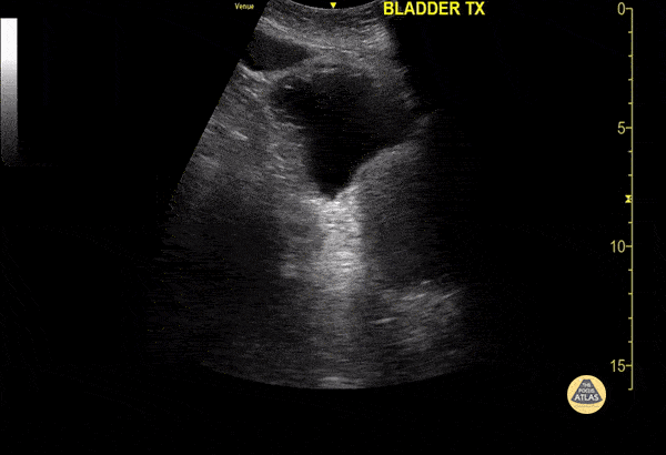 Renal/GU - Anterior Bladder Diverticulum
