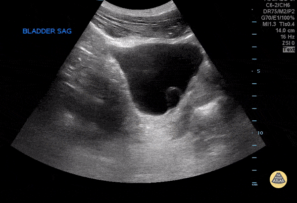 Renal/GU - Ureterocele